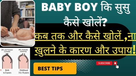 How To Open Baby Boy Private Part बेबी बॉय का लिंग की स्किन सरकती नही