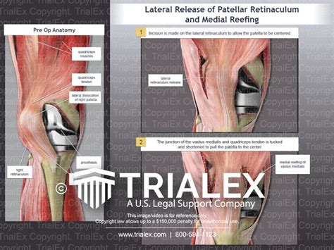 Lateral Release Of Patellar Retinaculum And Medial Reefing Tria