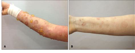 Figure 1 From Intravenous Immunoglobulin Therapy For Persistent