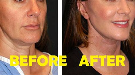 How To Get Rid Of Jowls Without Surgery Youtube