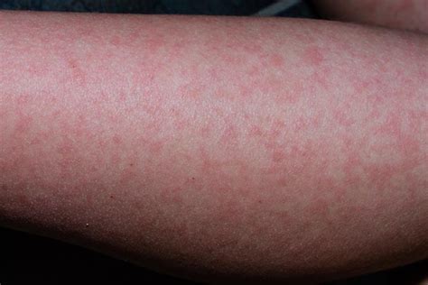 Viral Rashes In Babies Types Treatment Prevention Tips