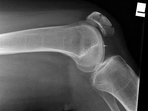 Lateral Knee Radiography Wikiradiography