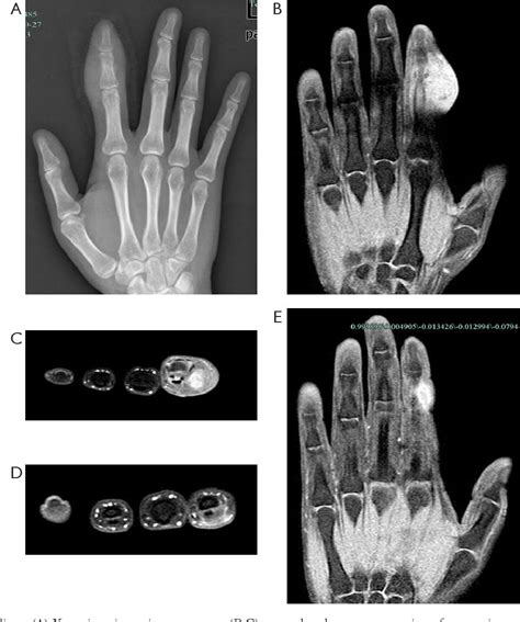 Figure 1 From Fibro Osseous Pseudotumor Of The Digit A Case Report