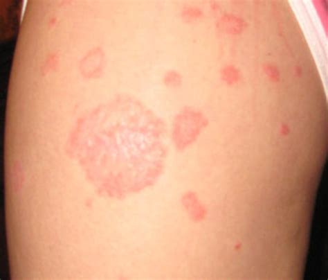Red Patches On Skin Causes Symptoms And Treatment