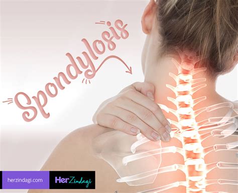 These 5 Things Can Help In Cervical Spondylosis Herzindagi