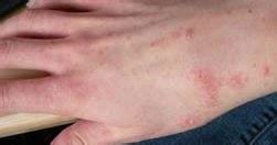 Pada beberapa kasus, bintik merah terjadi akibat reaksi alergi terhadap sesuatu. AL HIJRAH MUAMALAT: PETUA HILANGKAN GATAL-GATAL DAN SAKIT ...