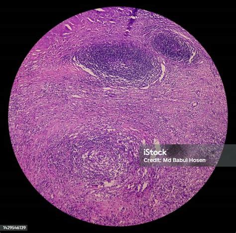 Photomicrograph Of Lymph Node With Hodgkins Disease Nodular Sclerosis