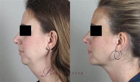 Chin Augmentation In Paramus Bergen County Nj Parker Center For