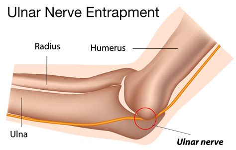 Ulnar Nerve Release Surgery Milwaukee Wi Cubital Tunnel Syndrome