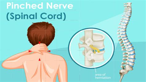 Pinched Nerve Pain Kirkland Read Our Chiropractic Blog