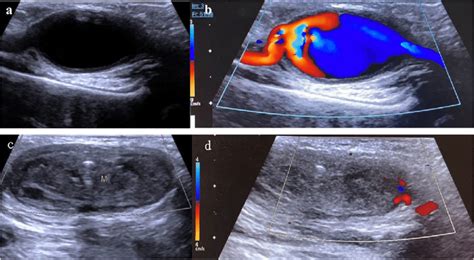 The Ultrasound Images Of Bilateral Axillary Artery Aneurysm A B The