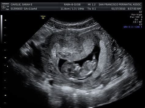 Maxs Baby Book 11 Week Ultrasound