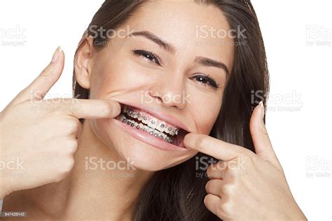 Face Of A Young Woman With Braces On Her Teeth Stockfoto Und Mehr