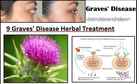 9 Graves Disease Herbal Treatment You Should Not Ignore Herbs
