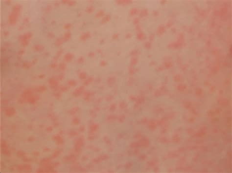 Viral Rashes In Adults