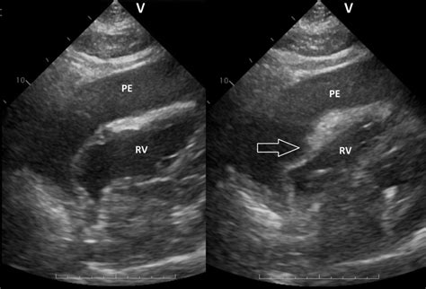 Typical Echocardiographic Appearance Of Cardiac Tamponade Note Huge