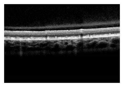 Fundus Photograph Of Two Eyes With Fundus Albipunctatus Shows Many