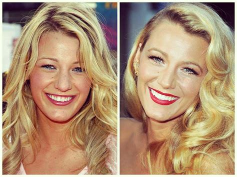 Blake Lively Nose Job Before And After
