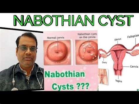Nabothian Cyst Cause Symptoms Homeopathic Medicine Youtube