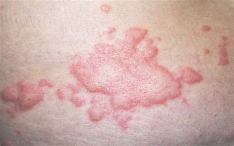 Treatment For Chronic Spontaneous Urticaria Approved By Nice Mims Online