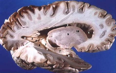 Filehuman Brain Right Dissected Lateral View Description Wikipedia