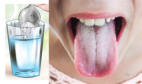 Home Remedies for a White-Coated Tongue | Top 10 Home Remedies