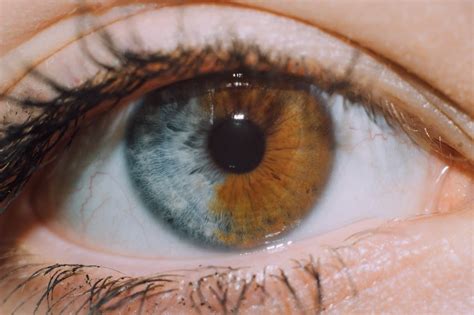 my friend s iris is split in half heterochromia eyes pretty eyes color different colored eyes