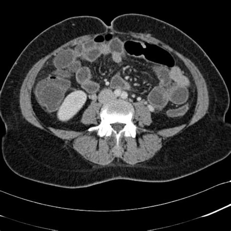 Appendicitis Ct Radiopaedia It Is A Very Common Condition In General