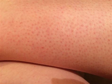 Red Blotches On Lower Legs Pictures Photos