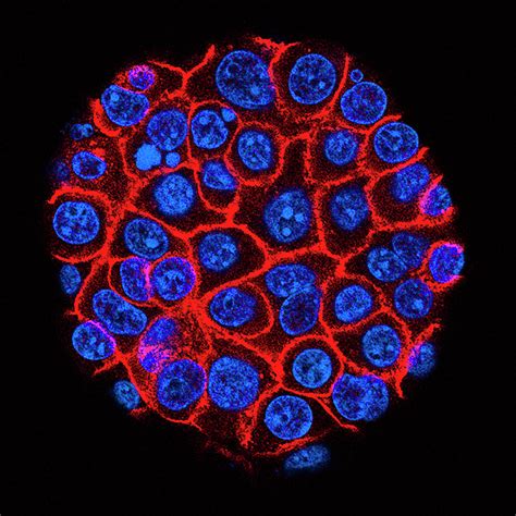 Pancreatic Cancer Cells Photograph By Usc Norris