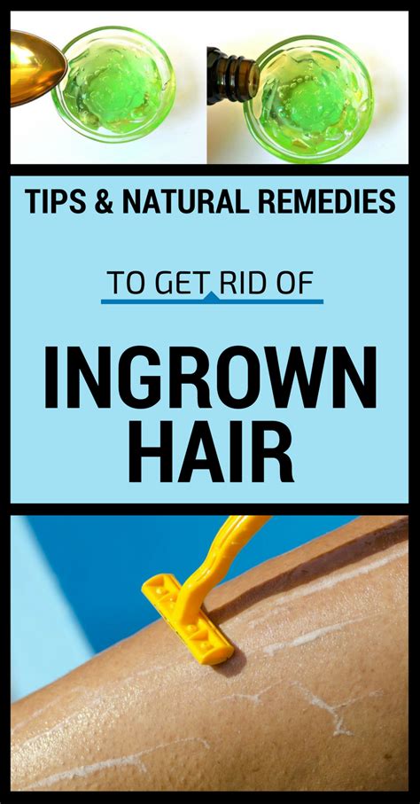 Tips And Natural Remedies To Get Rid Of Ingrown Hair Ingrown Hair