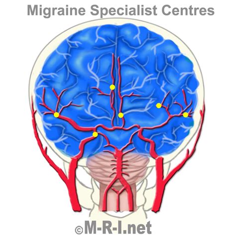 Arterial Surgery For Sporadic Hemiplegic Migraine Medical Research