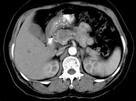 Contrast Enhanced Abdominal Computed Tomography Showing An Ill Defined