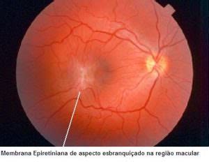 Especialista Em Membrana Epirretiniana Preti Eye Institute