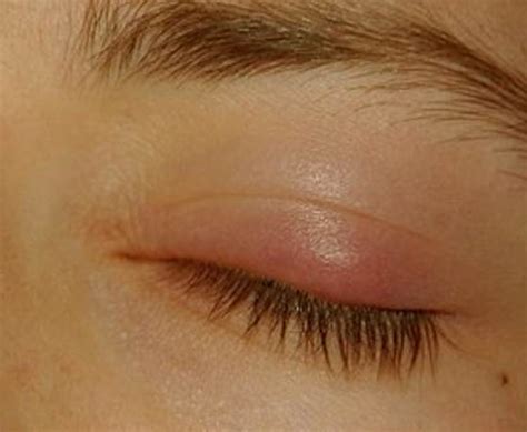 Bump On Eyelid Symptoms Causes Treatment Pictures