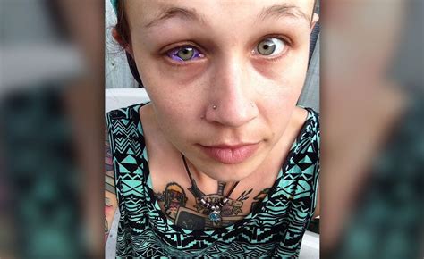Model Gets Eye Tattooed And It Goes Horribly Wrong Ny Daily News