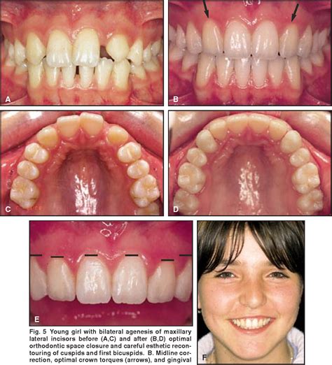 Figure 4 From Integrating Esthetic Dentistry And Space Closure In