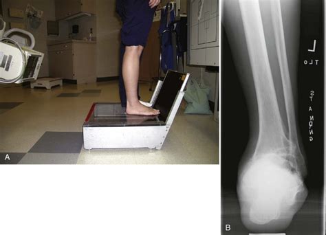Ankle Arthritis Musculoskeletal Key