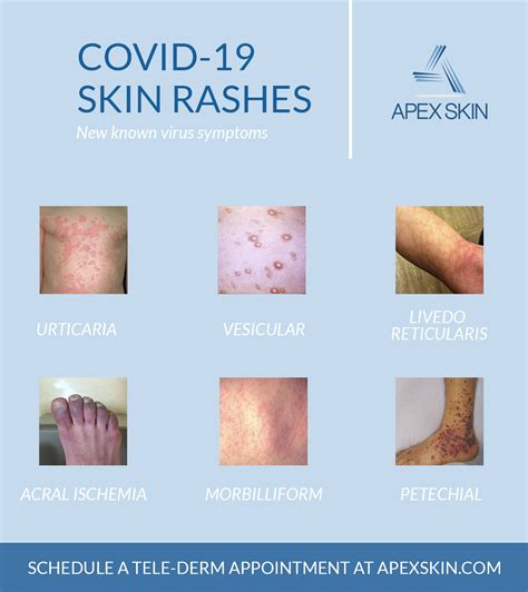 New In Covid 19 Skin Rashes Linked To Virus Apex