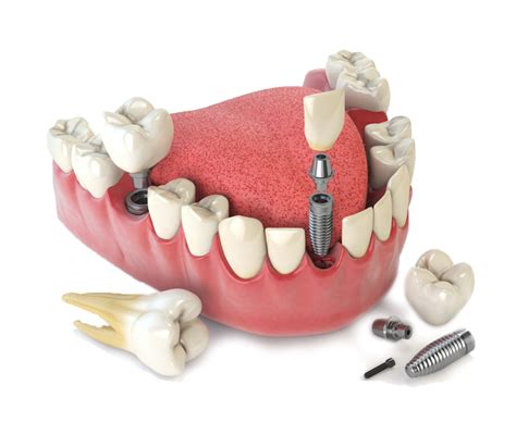 Same Day Dental Implants | Metroplex Surgical Arts