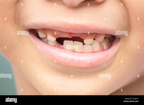 Baby Teeth Are Just Dropped In The Mouth Stock Photo Alamy