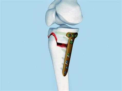 High Tibial Osteotomy Surgery In Bangalore Joint Preservation Surgery