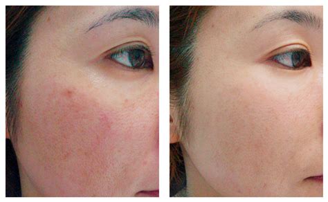 Before And Afters Territorylaserclinic
