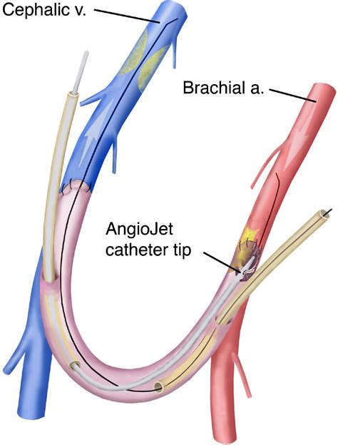 Catheter Interventions For Hemodialysis Fistulas And Grafts Jacc