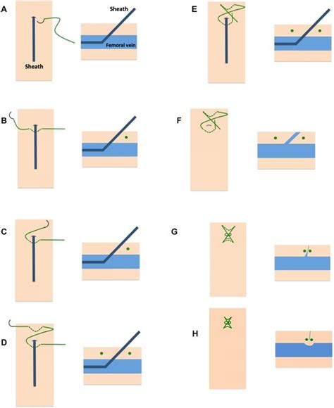 Feasibility Of The Figure Of 8 Suture As Venous Closure In