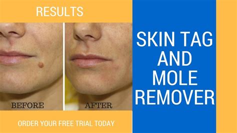 Practical skin tag remover kits mole removal micro band for face care tool ✾. Skin Tags and Mole Removal - YouTube