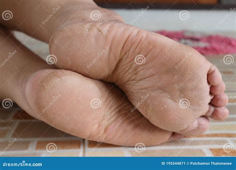 Close Up Woman Feet Cracked Heels Dry Skin Real Body Medical Concept