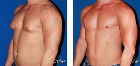 Bodybuilder Gynecomastia Expert Surgeon Dr Cruise Can Help