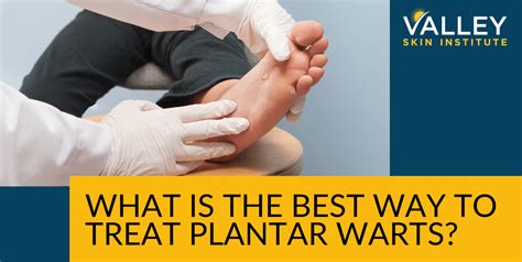 What Is The Best Way To Treat Plantar Warts