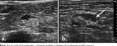 Figure 12 From Ultrasonography Of Superficial Lymph Nodes Benign Vs